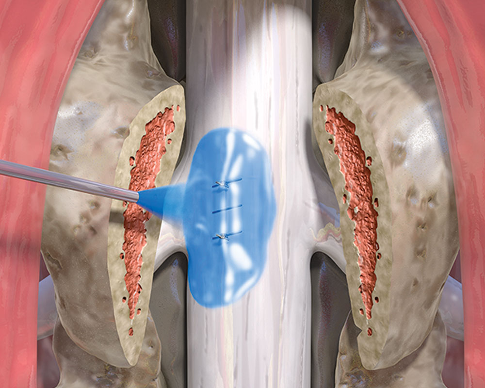 DuraSeal Xact Spinal Dura Yapıştırıcı