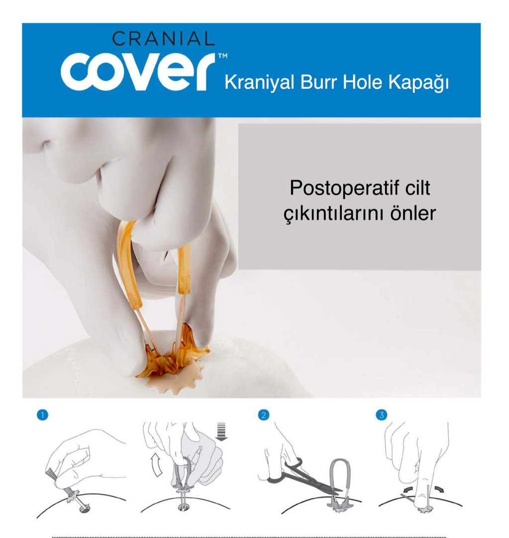 Neos Kafatası Fiksasyon