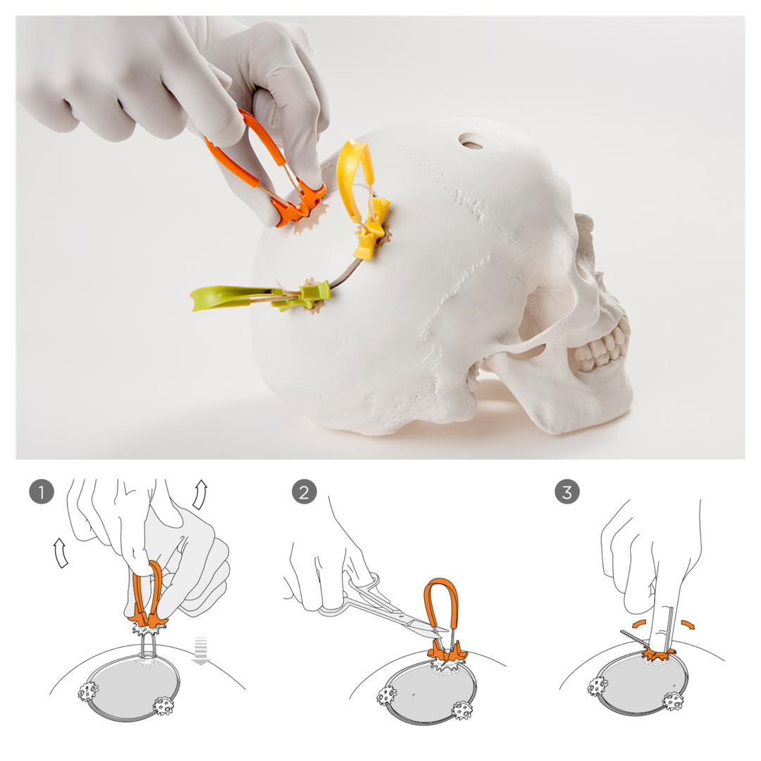 Neos Kafatası Fiksasyon