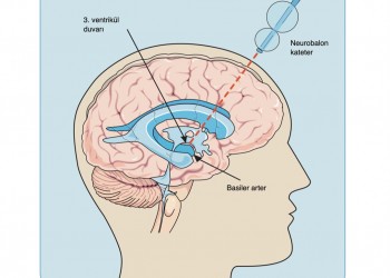 Neurobalon Kateter