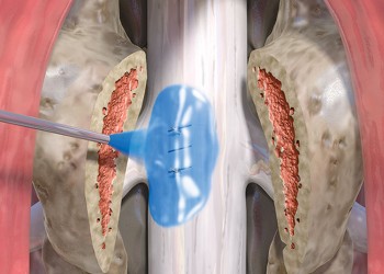 DuraSeal Xact Spinal Dura Yapıştırıcı