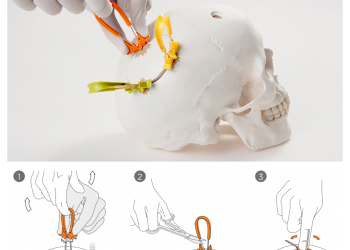 Neos Kafatası Fiksasyon