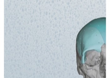 Codman Cranioplastic